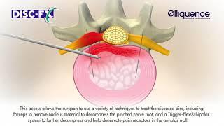 Удаление межпозвоночной грыжи малоинвазивным методом