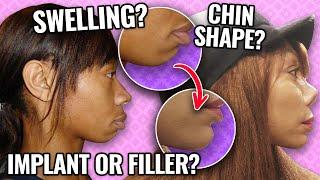 Getting a chin implant? Watch this first! | Opt into Beauty