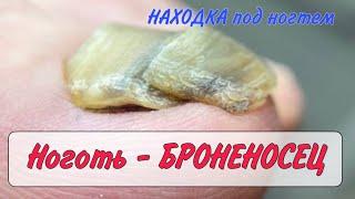 Волосы под ногтем / толстый ноготь / ретронихия / онихогрифоз