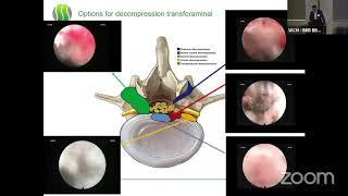 Transforminal Endoscopy  Step By Step   Ralf Wagner