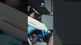 Come and get some laser tattoo therapy at OSCO London #medicaltattoo #tattoomed