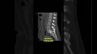 Best way to decrease spondylolisthesis pain...