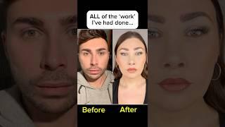 My face TRANSFORMATION ️‍️ #transgender #beforeandafter #surgery #transformation #mtf