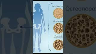 Остеопороз и эндопротезирование. Профилактика рисков в полном видео (ссылка в описании)