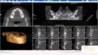 Tips and Tricks i-CAT Vision