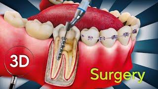 Root Canal Treatment ( Surgery ) : 3D Animation