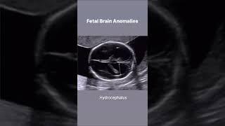 fetal brain anomalies#ultrasound #imaging #medicalimaging #learning #viral #medicine #doctor