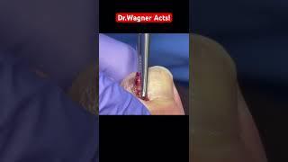REMOVAL OF AN INFECTED GOOEY INGROWN TOENAIL#shorts