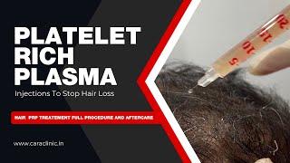 Platelet Rich Plasma Injections To Stop Hair Loss | PRP Treatment Full Procedure.