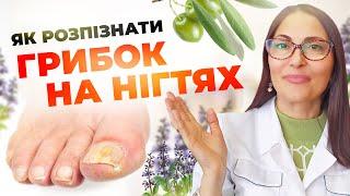 Як розпізнати грибок на нігтях?