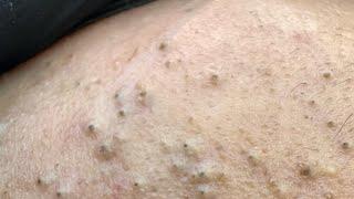 Purea Korean Pimple Treatment (For Clear, Acne-Free Skin)