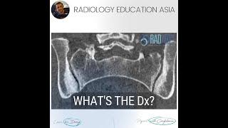 WHAT'S THE Dx: OSTEITIS CONDENSANS ILII SIJ CT RADIOLOGY