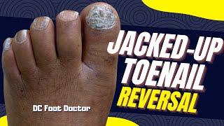 Jacked Up Toenail Reversal