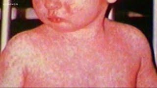 Health officials confirm third measles case in Maryland, warn of possible exposures