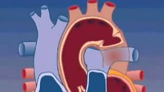 Coarctation of the Aorta