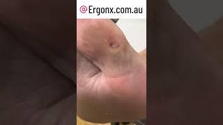 Painful big toe callus cutting and removal in podiatry clinic