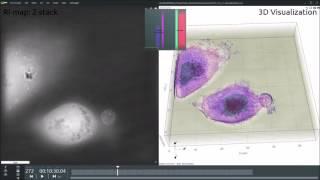 Living T-cell killing a living cancer cell