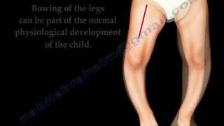 Bow Legs In Children - Everything You Need To Know - Dr. Nabil Ebraheim