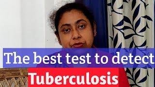 how you kno you hav  pulmonary tuberculosis|diagnosis of tuberculosis