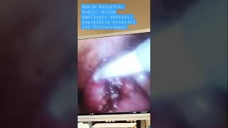 YAPIŞIKLIK ÖNLEYCİ JEL  RAHİM KORUYUCU MİYOM AMELİYATI    (Prof Dr Hüseyin CENGİZ)