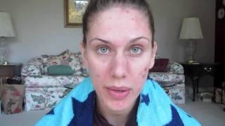 Acne Update! + RANT/RAGE. Skin Journal: Does Dairy Cause Acne: DiamondsAndHeels14 Cassandra Bankson