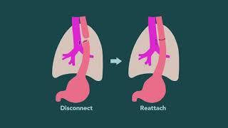 Esophageal Atresia | Dr. Nitsana Spigland | Weill Cornell Medicine Surgery