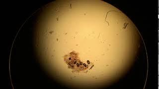 Scabies Mite, eggs, scybala