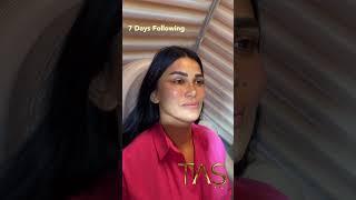 Face, Neck, Temporal & Forehead Lift, Fat Grafting, Laser Skin Tightening by Dr. Suleyman TAS