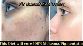 This Diet will cure 100% your Melasma/Pigmentation | how to remove pigmentation | freckle treatment