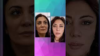 Ameliyatsız Fransız Askısı Deep lift yüz germe nasıl yapılır #aesthetics #estetik #lifting