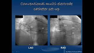 Mapping and ablation of atrial flutter -  Dr  Rania Samir