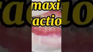 InterMaxillary Elastic|How we will force the tooth to move|Ortho intermaxillary traction|Orthodontic