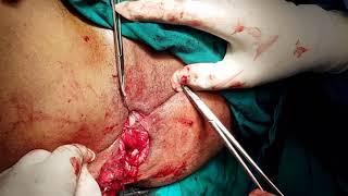 How to treat rectal prolapse in a male patient? Delorme’s Procedure with Levatorplasty