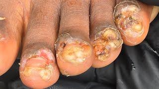 Rehema Teye's big clear jiggers #2 -- watch long videos @riseupsociety.net & @ruskenya.org