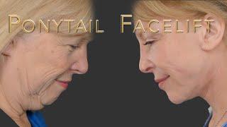 Ponytail Facelift Transforming Smiles: From Pre-Op To Confidence.