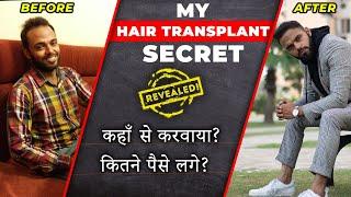 MY HAIR TRANSPLANT SECRETS REVEALED  | Before & After | Be Ghent