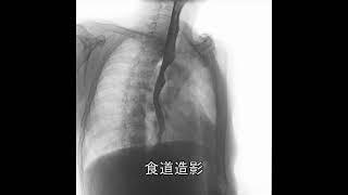 Esophageal Xray Angiography食道造影 #xraytechnician #hospital #fujifilm #medicaldevice #medicalequipment