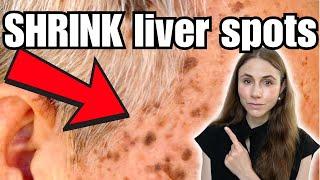 How To Shrink Liver Spots: Home Remedies THAT WORK