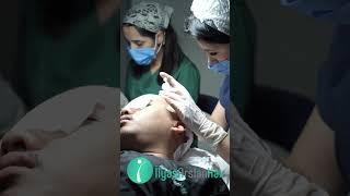 Meet Mr. Dimas doing hair transplant in Ilyas Arslan Hair! #skincare #hairtransplant #tanamrambut