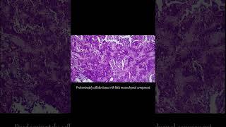 A case of Pleomorphic adenoma