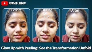 Peeling Procedure Step by Step | Skin peeling Day by Day | Peeling Results by Dr. Vijay Kumar