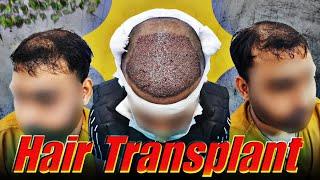 Hair transplant in jabalpur | Amazing Hair Transplant Journey | Best Hair Transplant Result | Avista