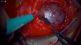 Surgery: Simple Limbal Epithelial Transplantation (SLET): Dr. Roberto Pineda