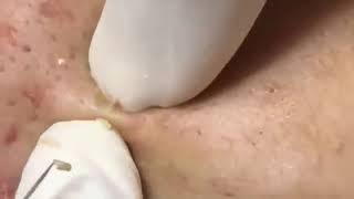 CRAVOS E ESPINHAS  - Removendo Cravos e espinhas Gigantes tirando Cravos e Espinha do rosto