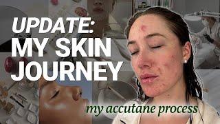 My honest Accutane journey part 2: side effects & skincare essentials!