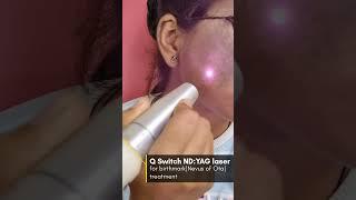 Birthmark removal (Nevus of Ota) By Q switch Nd:YAG laser 