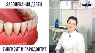 Заболевание десен – гингивит, парадонтит