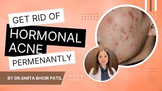 Hormonal Acne -Top 6 Strategies | Hormonal Acne ka जड़ से इलाज | Dr. Smita Bhoir Patil (Hindi)