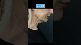 INSANE NECKLIFT TRANSFORMATION