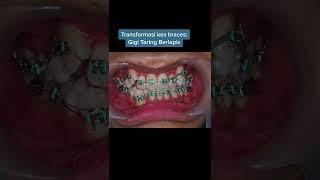 Braces for Crowded Canines | Braces Untuk Gigi Taring Berlapis